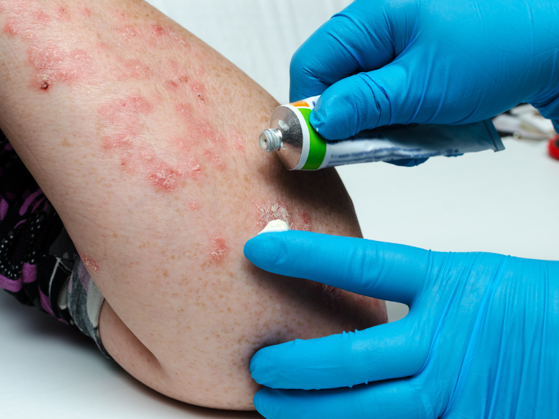 Biologic Therapy For Psoriasis Raleigh Nc